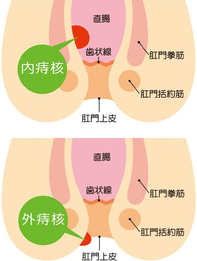 いぼ痔(痔核)