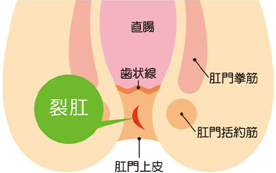 切れ痔(裂肛)
