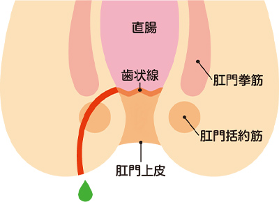 痔ろう(あな痔)