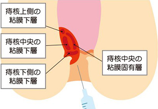 ジオン注射（ALTA療法）