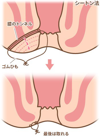 瘻管切開開放術（Lay Open法）
