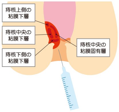 ジオン注射（ALTA療法）について